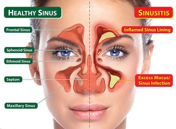 23 Powerful Home Remedies For Sinus Headaches