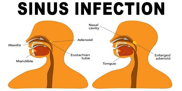 4 Home Remedies to Quickly Get Rid of Sinus Infections ...