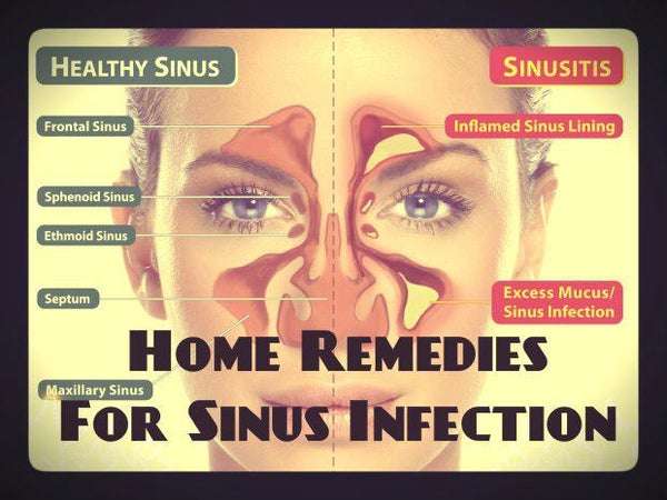6 Natural Home Remedies For A Sinus Infection  Me First ...