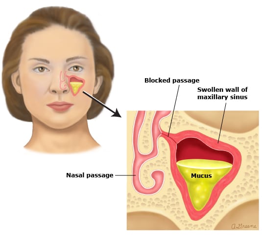 70 sinus infection mucus images 282211