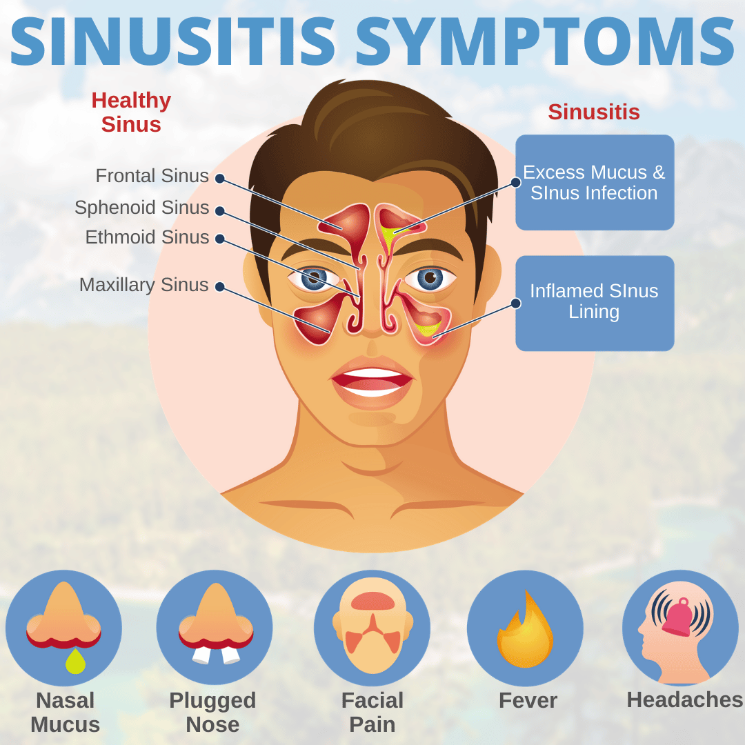 80 Best Of What Are The Symptoms Of Ethmoid Sinusitis