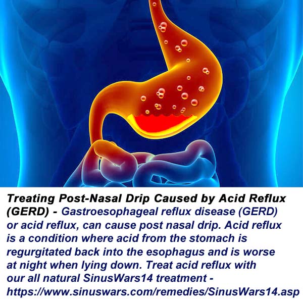 Acid Reflux Causes Post Nasal Drip