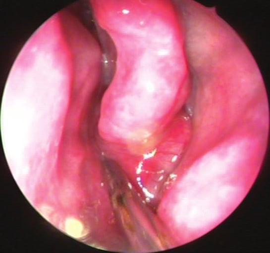 Adenoid cystic carcinoma of the nasal septum: A rare case report ...