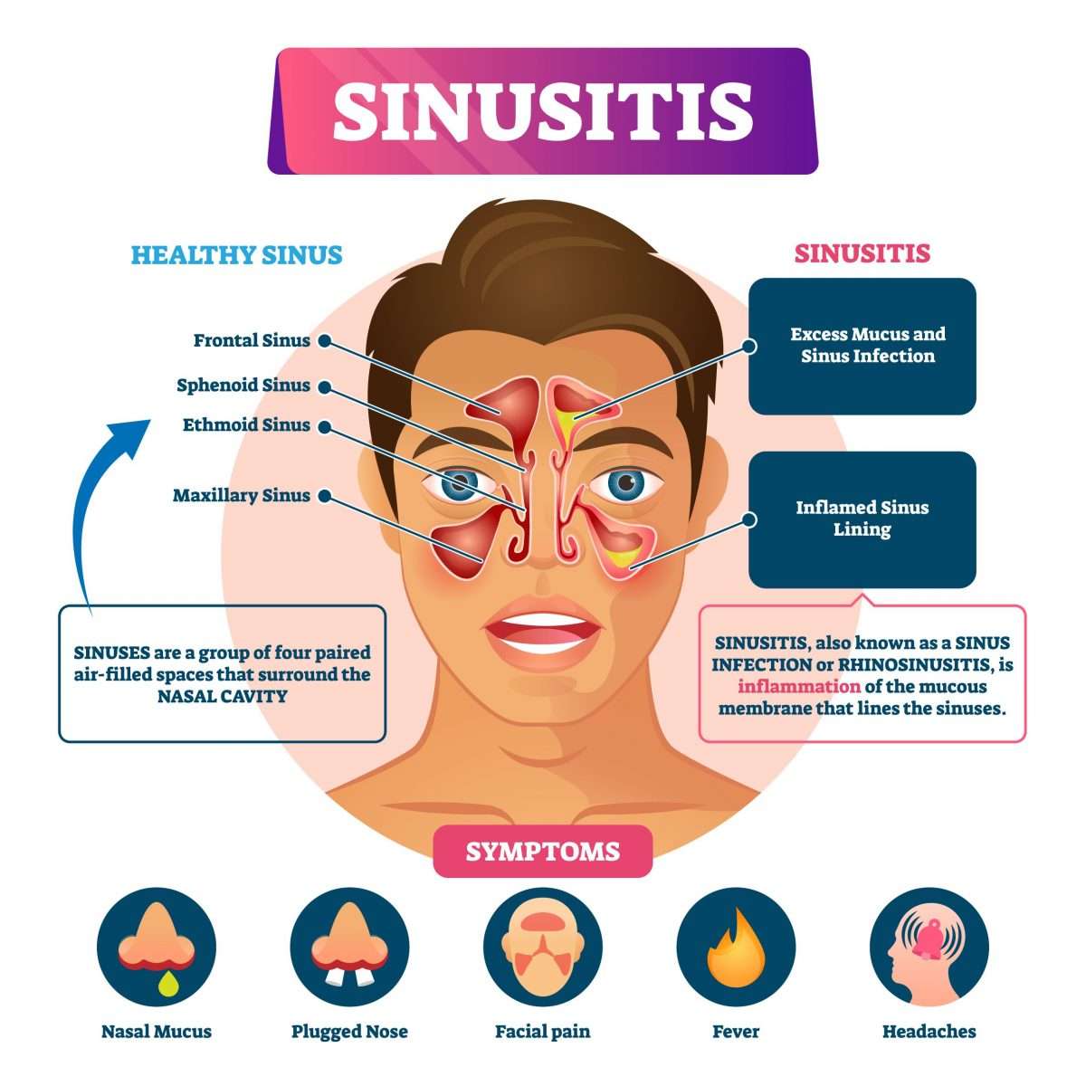 Allergies vs. Sinusitis