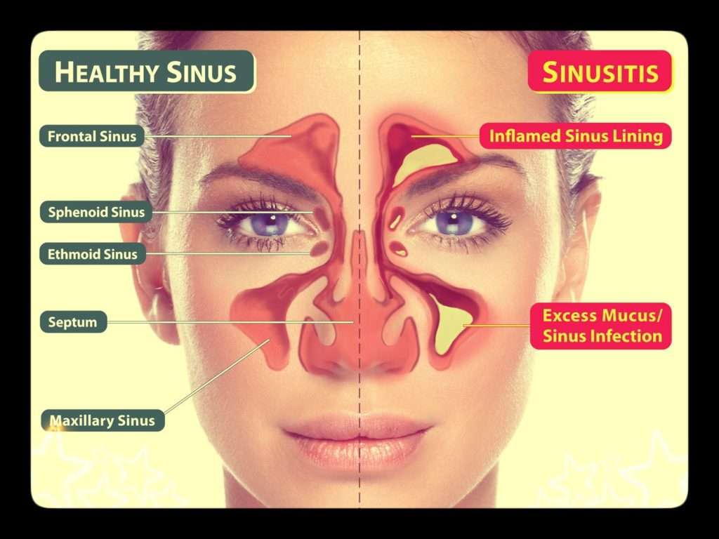 Antibiotics for sinus infection