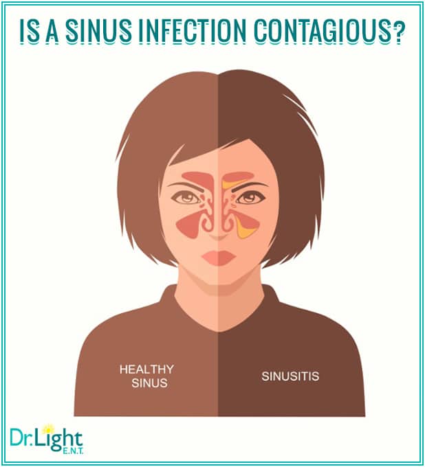 Are Bacterial Sinus Infections Contagious
