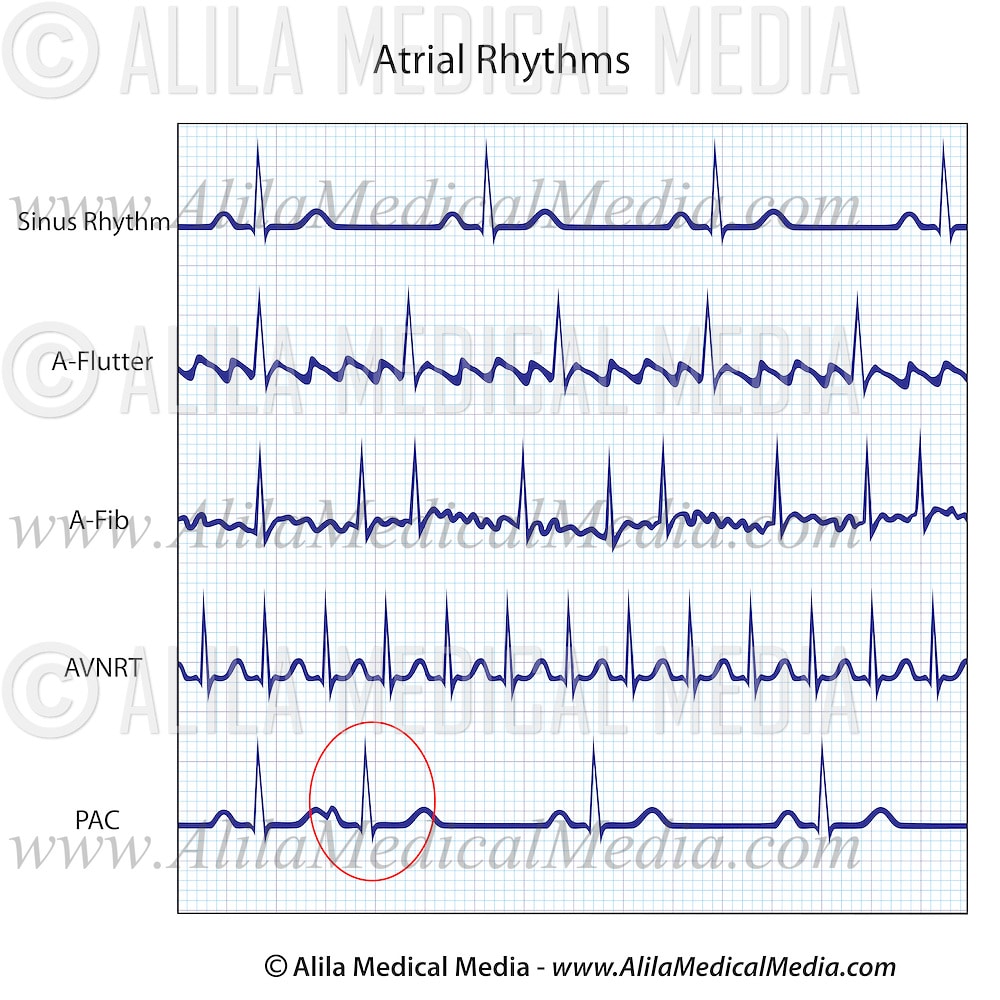 Atrial Rhythms ECGs
