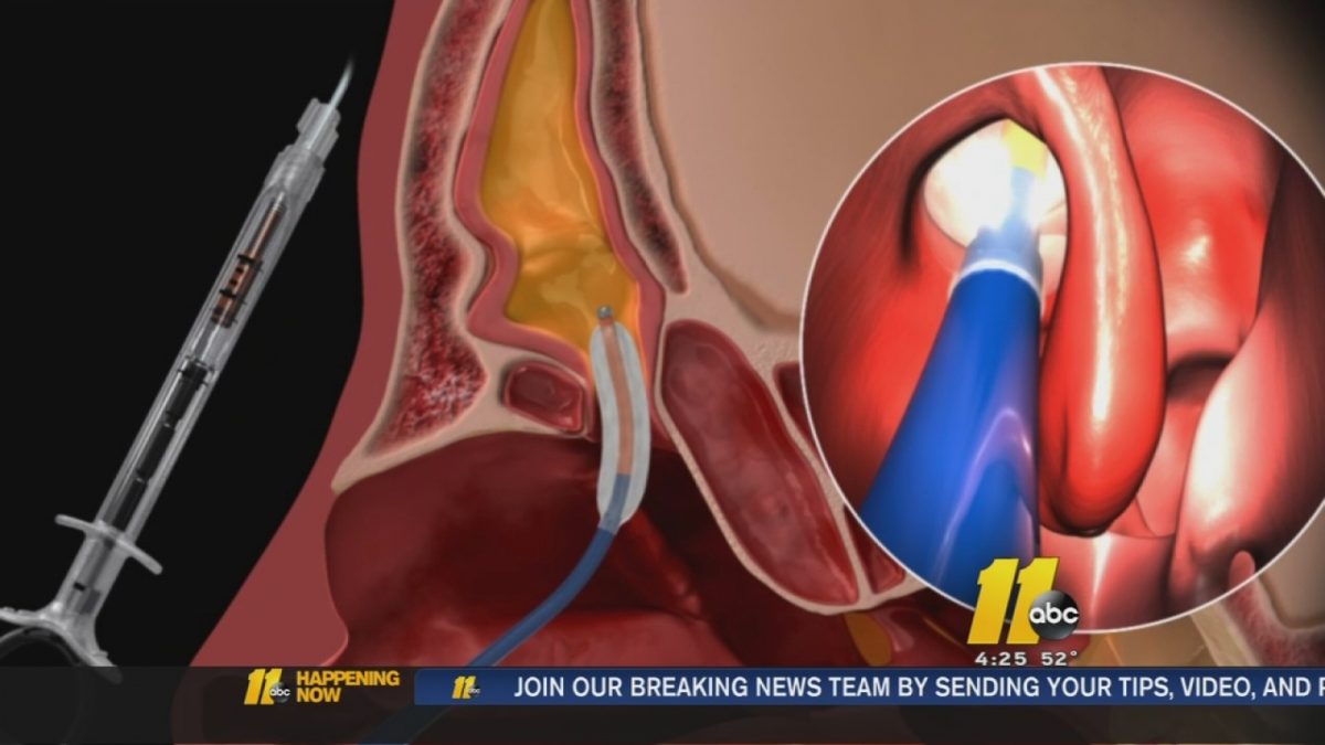 Balloon dilation procedure could help chronic sinus sufferers