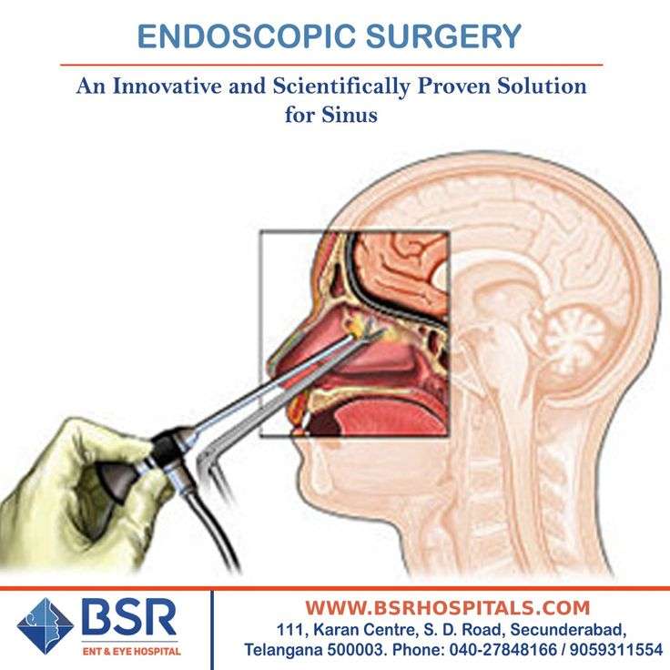 Balloon sinuplasty or sinus ostial dilation surgery is a newer method ...