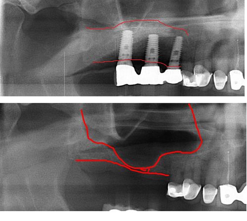 Burbank Sinus Lift Bone Graft for Dental Implants Case Example