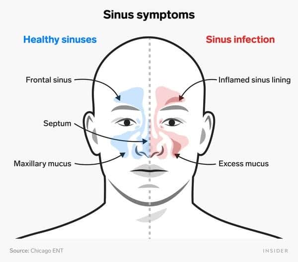 Can a Person Get Rid of a Sinus Infection Naturally