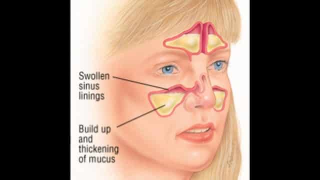 Can Acupuncture Help with Sinus Problems  For Your ...