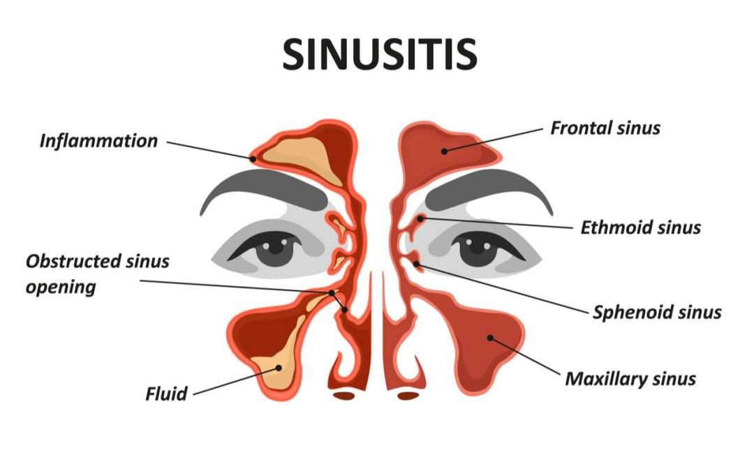Can sinus infection cause toothache? The answer is yes