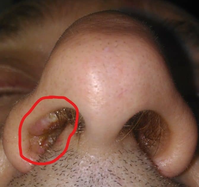 Carcinoma of the nasal vestibule