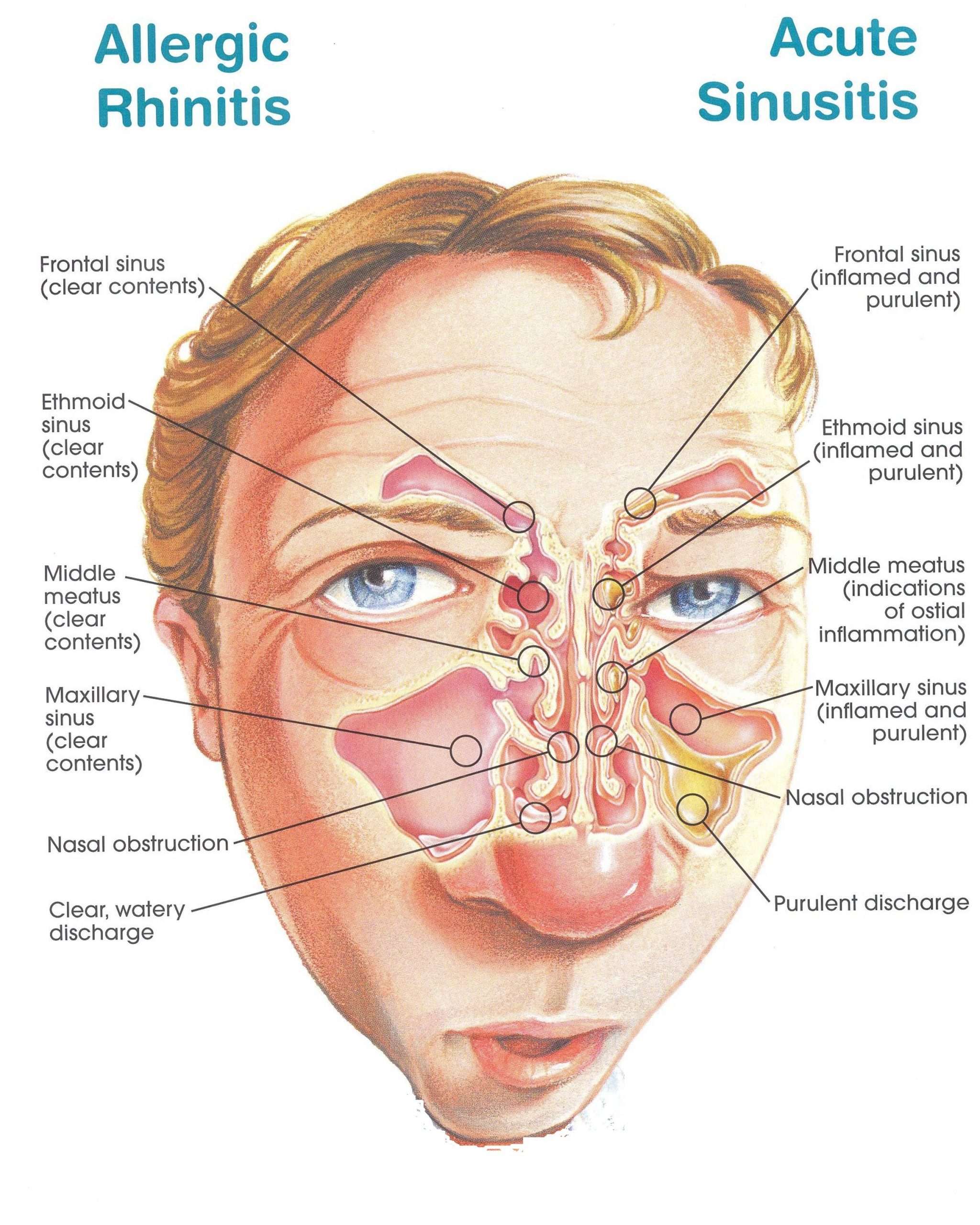 Chronic Sinusitis Medication How Treat Nasal Post Drip Rhinitis ...
