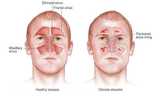 Common Symptoms of Sinusitis