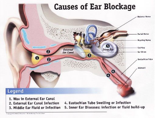 Conductive hearing loss examples