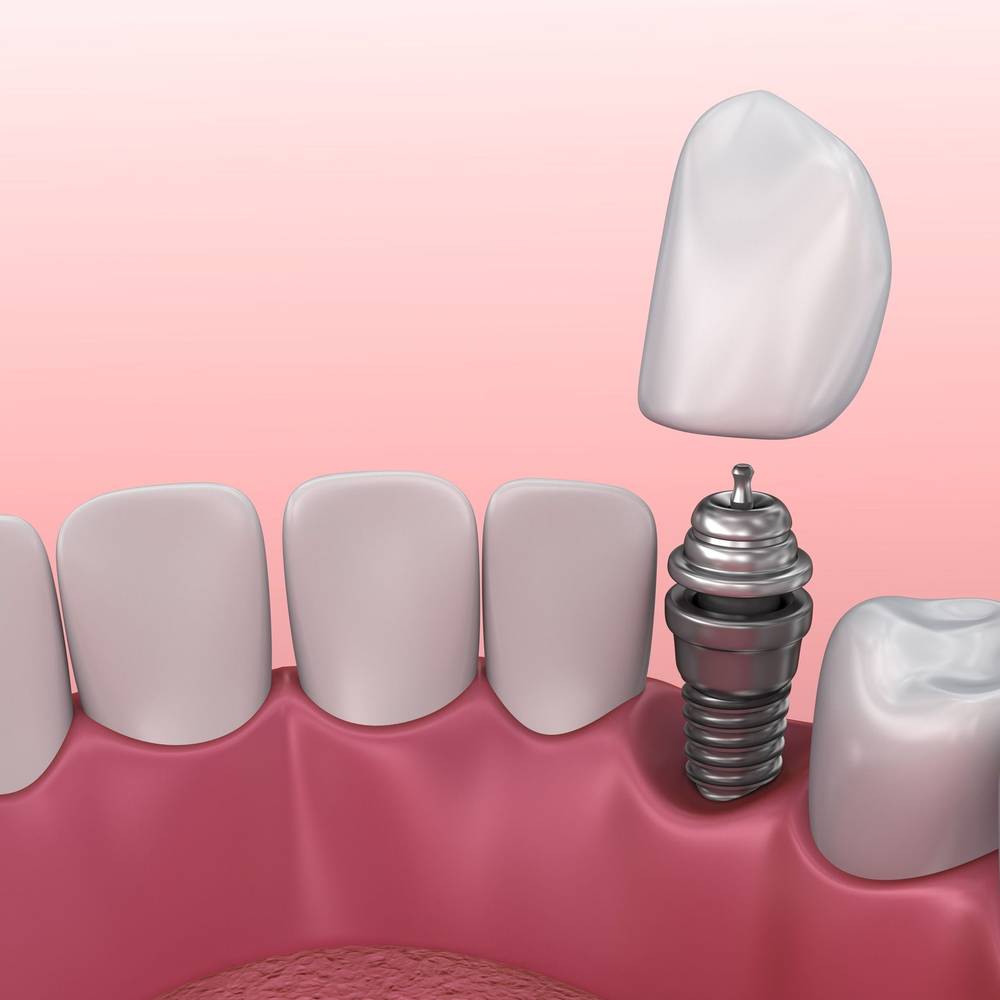 Dental Implant Cost Idaho Falls, ID