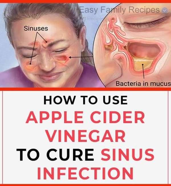 Does A Sinus Infection Clear Up On Its Own
