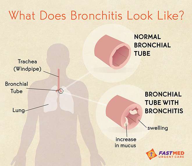 Dr Ajays Homeopathy : Homeopathy remedies for Bronchitis
