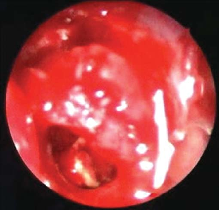 Endoscopic photograph showing a fungus ball in the left ...