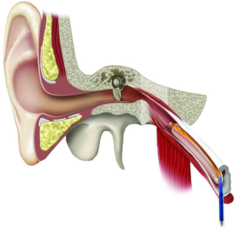 Eustachian Tube Dilation for Ear Pressure &  Fullness