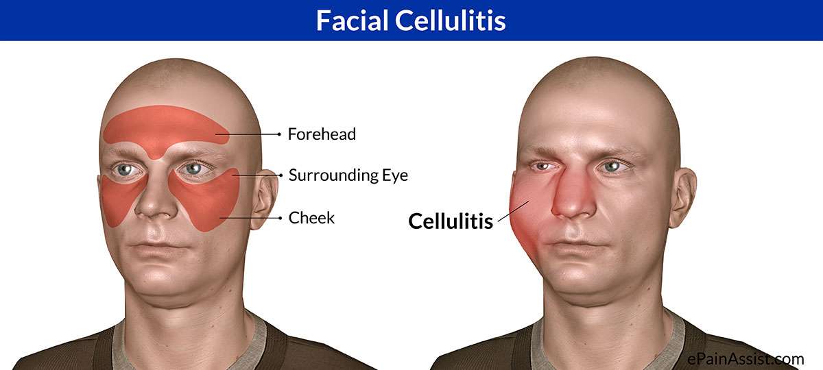 Facial Cellulitis