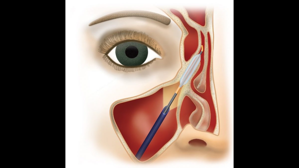 FinESS Balloon Sinus Dilation in the office under local anesthesia ...
