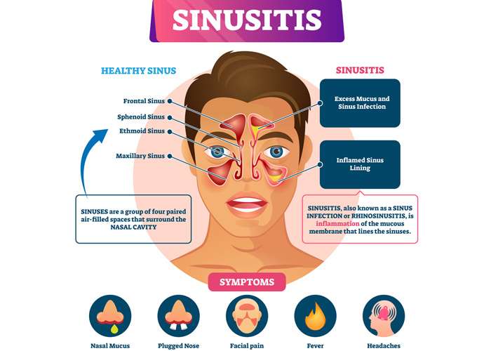 Here Are 9 Ways to Get Rid of a Sinus Infection, Plus Tips ...