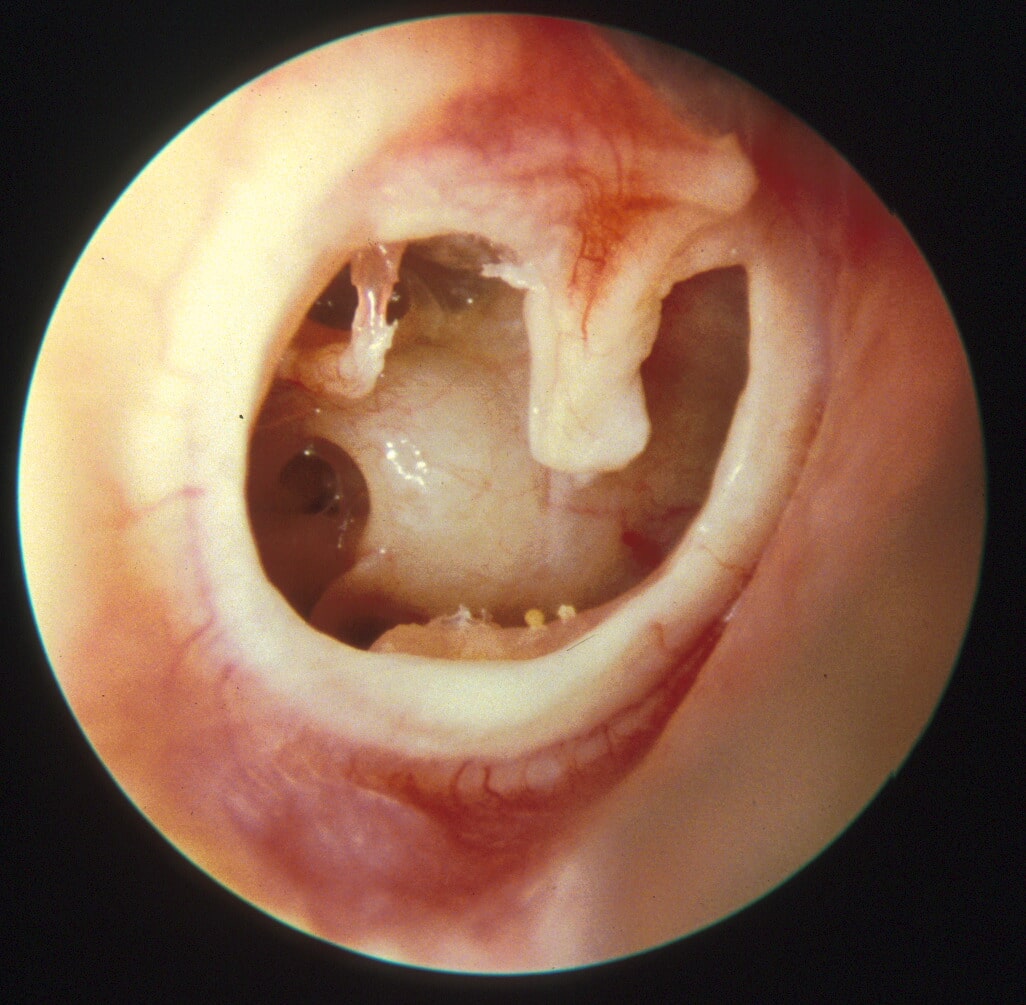 Hole In Ear Drum