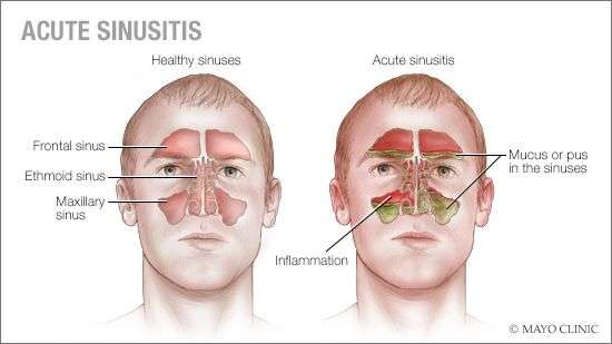 Home Remedies: Treating acute sinusitis without ...