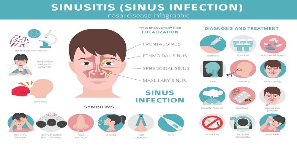 How do I tell if I have a sinus or migraine?
