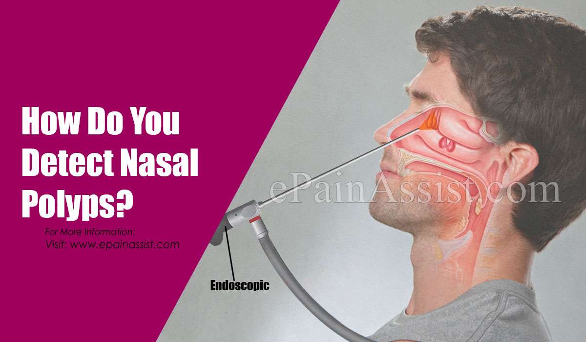 How Do You Detect Nasal Polyps &  Can Nasal Polyps Bleed?