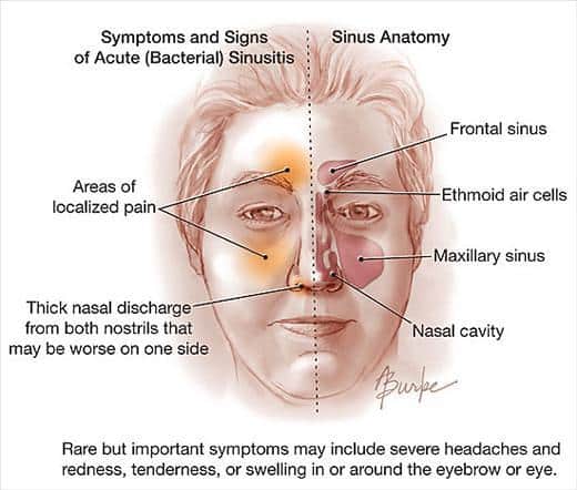 How Do You Know You Have Sinus Headache