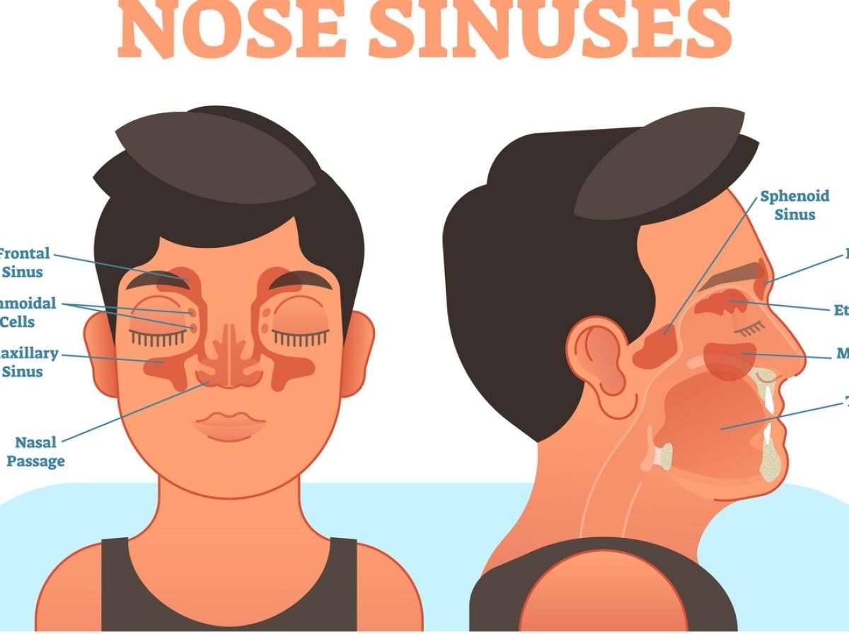 How Long Does Sinusitis Last