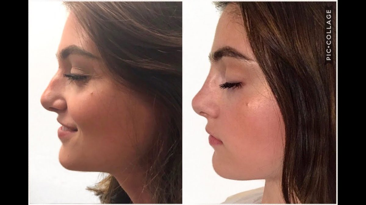 How Long Non Surgical Nose Job Last