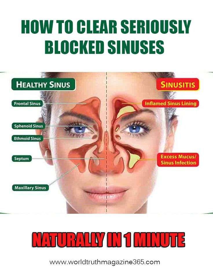 HOW TO CLEAR SERIOUSLY BLOCKED SINUSES NATURALLY IN 1 MINUTE