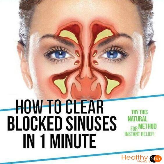 HOW TO CLEAR SERIOUSLY BLOCKED SINUSES NATURALLY IN 1 MINUTE ( VIDEO ...