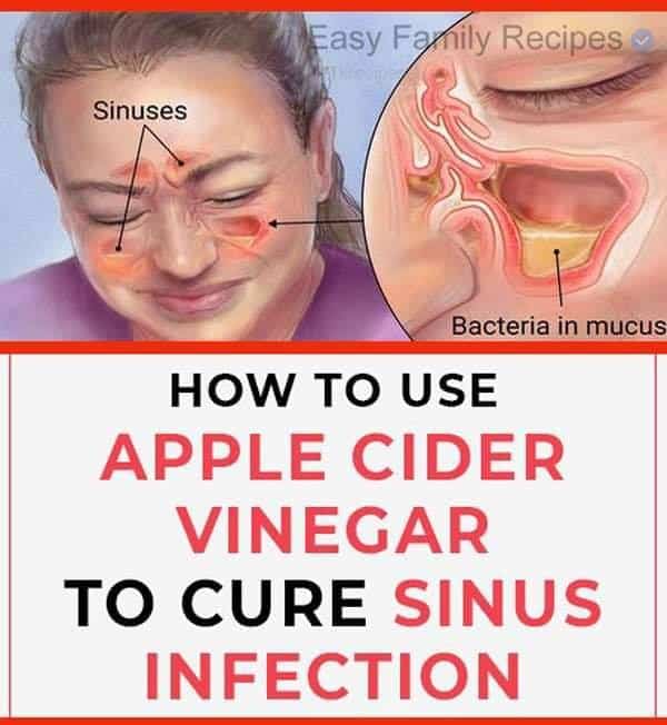How To Kill Sinus Infection Within Minutes With Apple Cider Vinegar ...