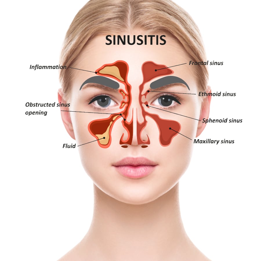 How to manage sinusitis naturally