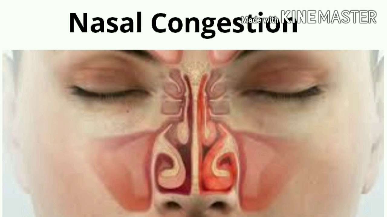 How to relieve from Nasal congestion