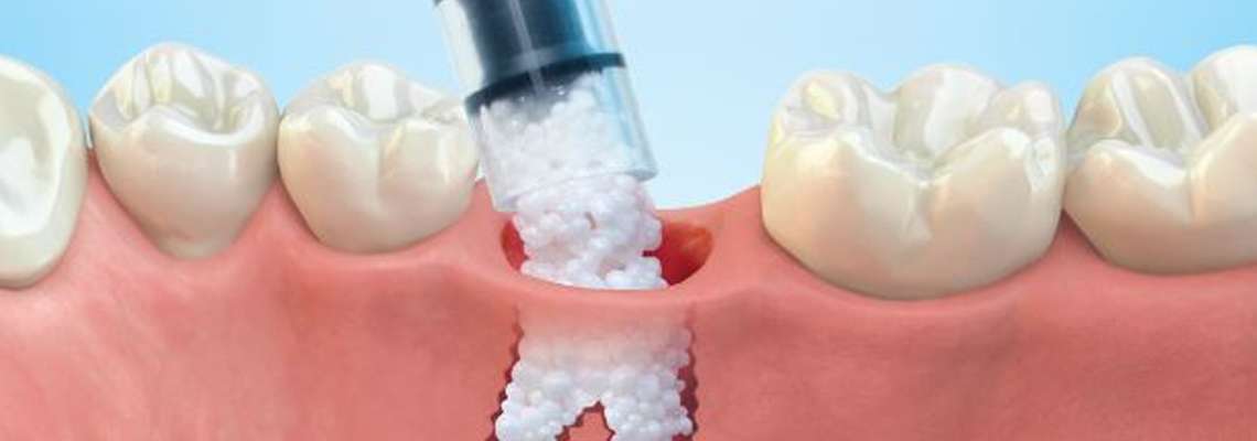 How to Save on Dental Bone Graft Cost?