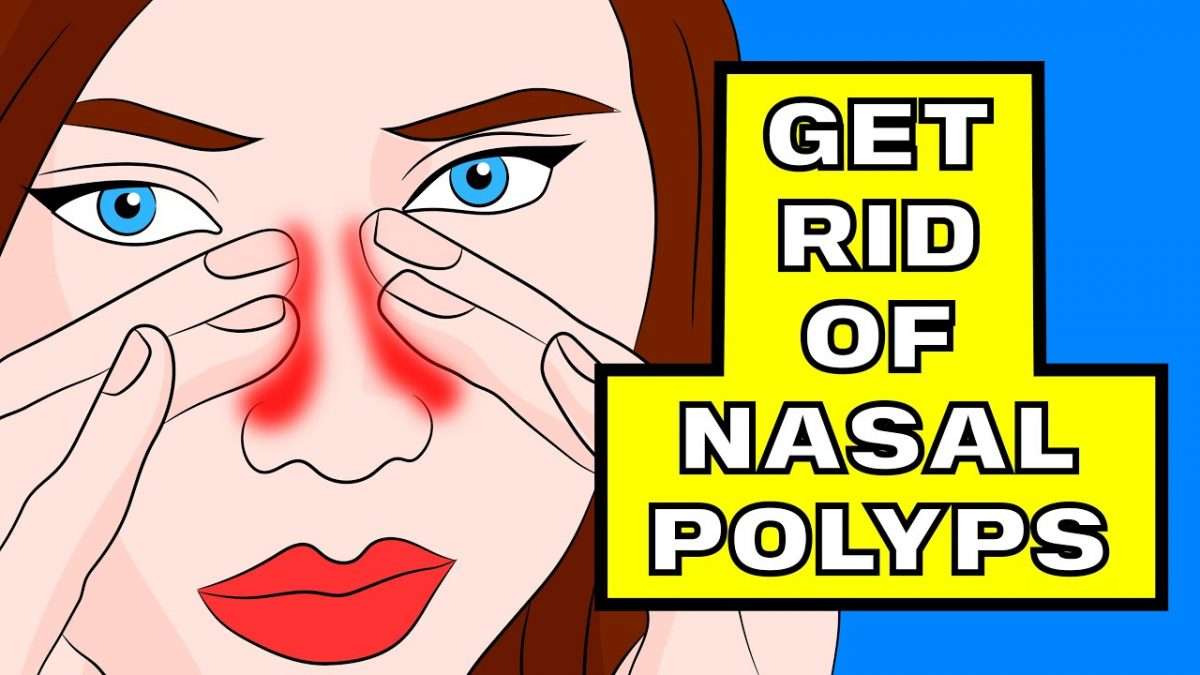 How to Shrink your Nasal Polyps in under 3 minutes WITHOUT surgery ...