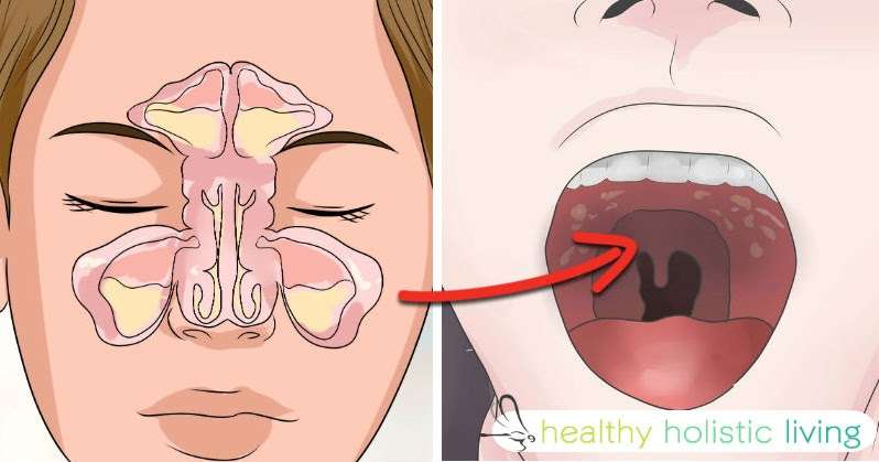 If You Get Sinus Headaches or CONSTANT Congestion You NEED To Check For ...