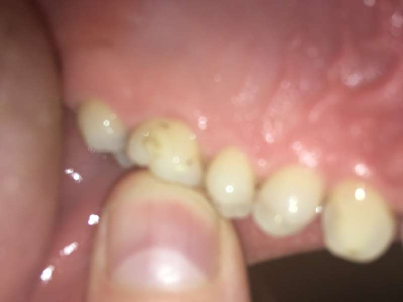 Infected Tooth Or Sinus Problem?