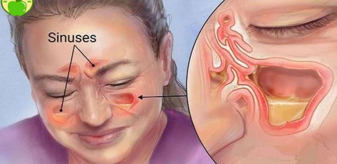 Is CBD Effective In Treating Sinus Infections ...