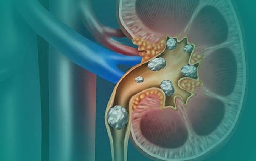 Kidney Stones &  Bladder Infections