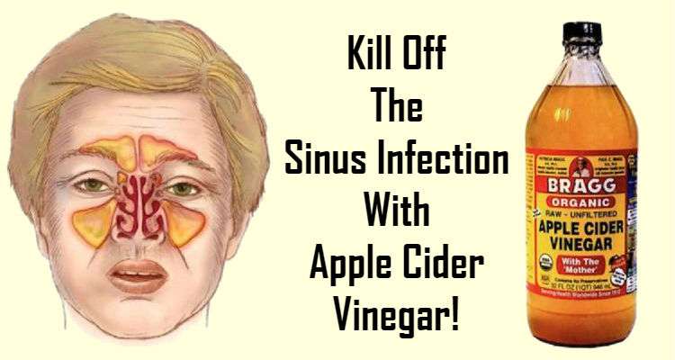 Kill Off The Sinus Infection With Apple Cider Vinegar!