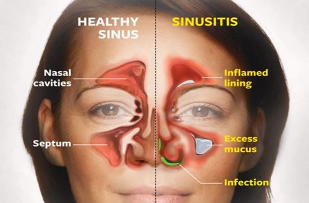 Kill Sinus Infection In 20 Seconds With This Simple Method And This ...