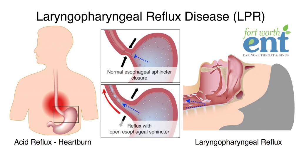 Laryngopharyngeal Reflux Disease (LPR)